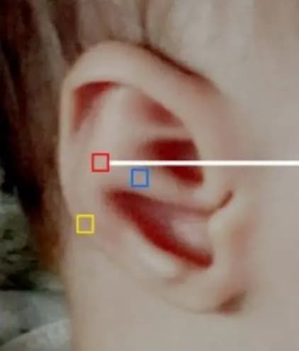 중간연골 튀어나온 귀